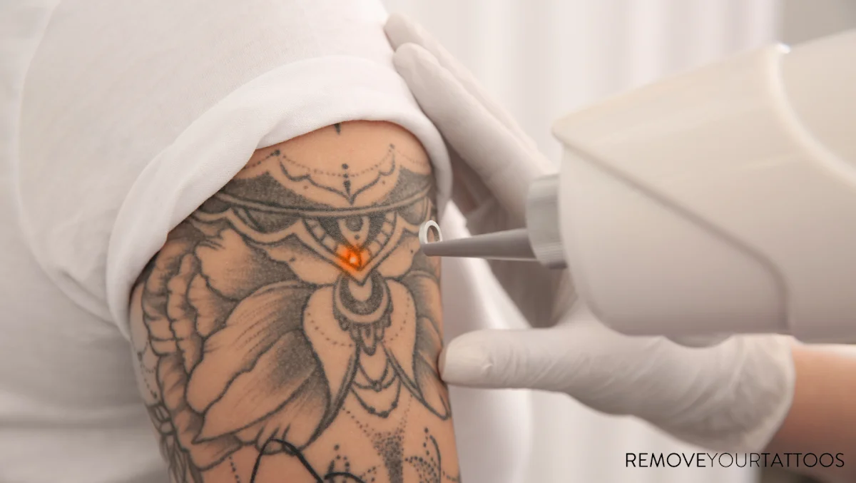 Remove Your Tattoos - Bolton tattoo shop in Bolton, ENG