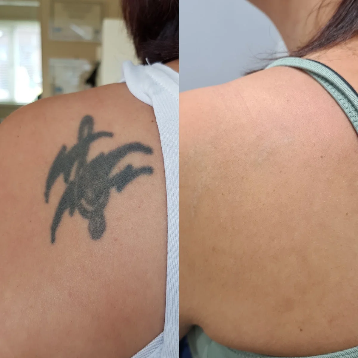The Missing Ink: Laser Tattoo Removal photo