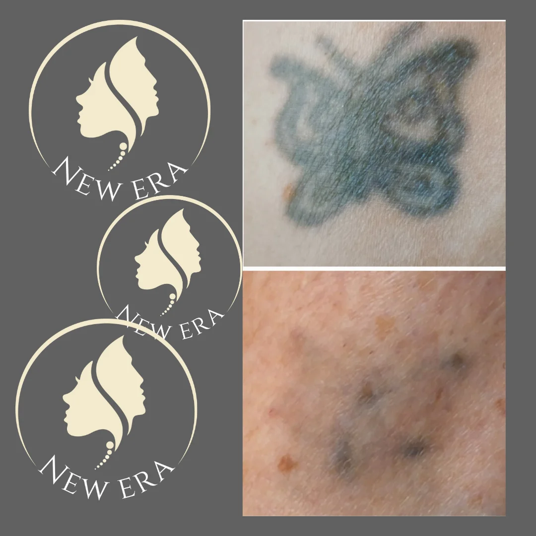 New Era - Tattoo Removal, Plasmafibroblast, Worcester, UK photo