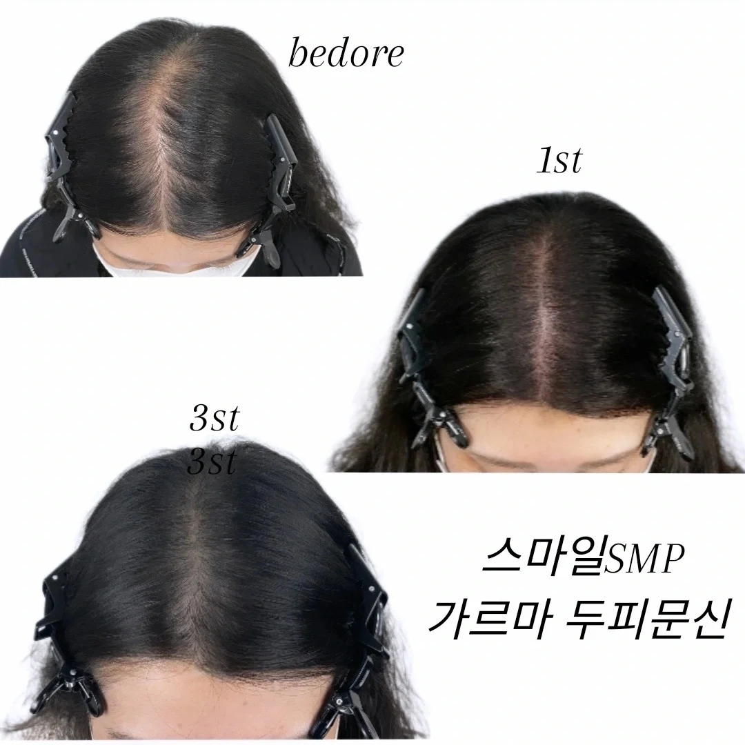제주 두피문신 /스마일smp 제주탈모커버 tattoo shop in Jeju City