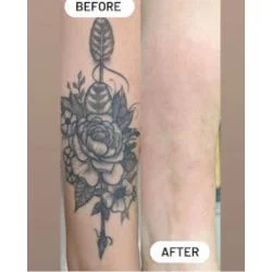 Bonsai Laser Tattoo Removal tattoo shop in Frisco, TX